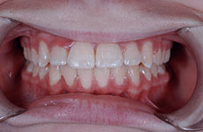 teeth after orthodontic treatment