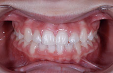 teeth after orthodontic treatment